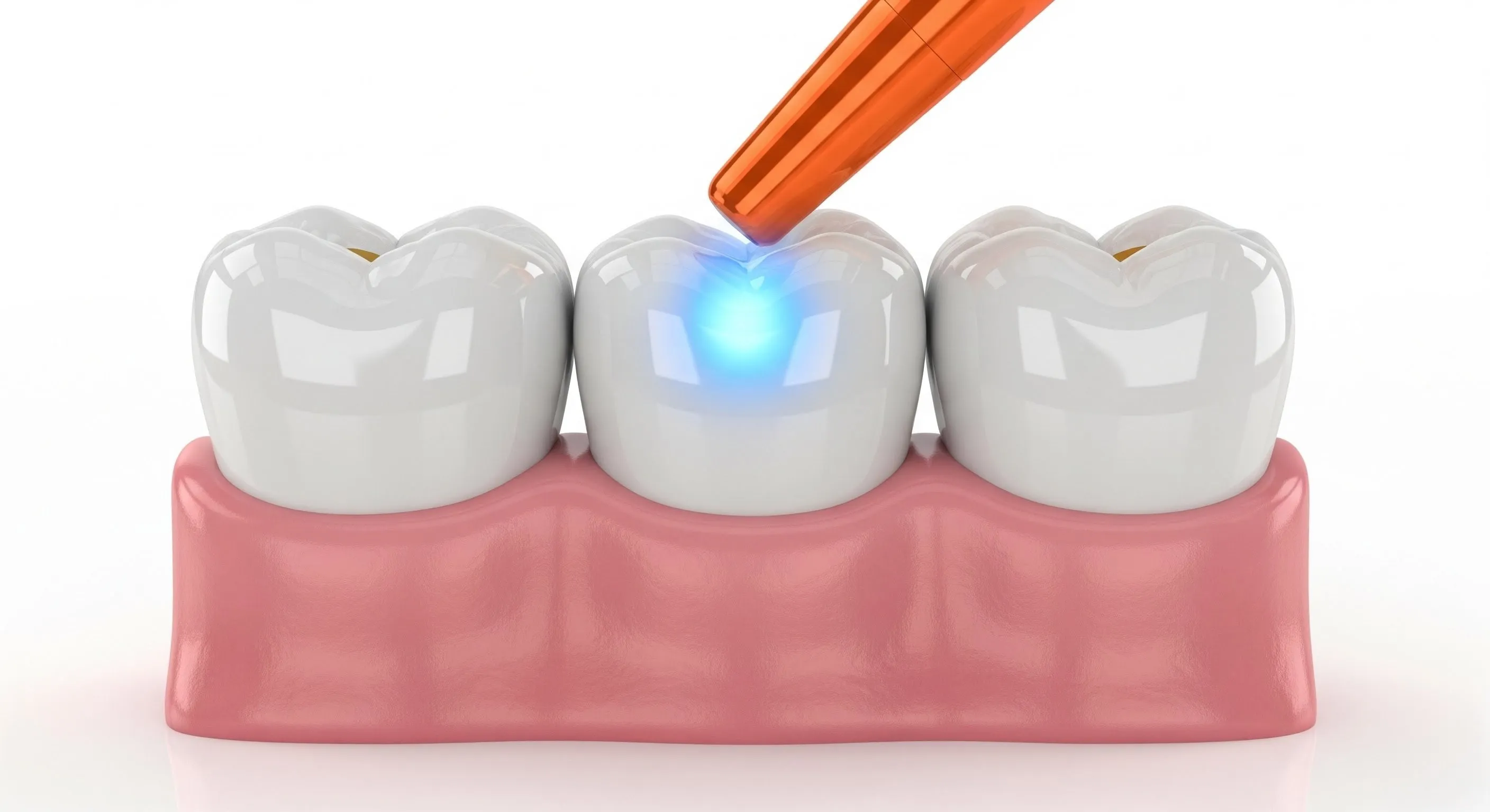 Composite Fillings Cost and Pricing Information in Winston Salem